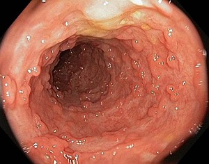 Bệnh viêm da cơ địa có lây không và một số vấn đề cần lưu ý