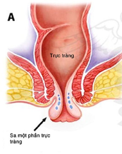 Bệnh viêm da cơ địa có lây không và một số vấn đề cần lưu ý